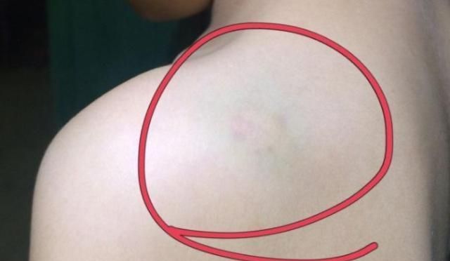 为什么女生身上容易青一块为什么女生身上容易青一块，探寻背后的原因
